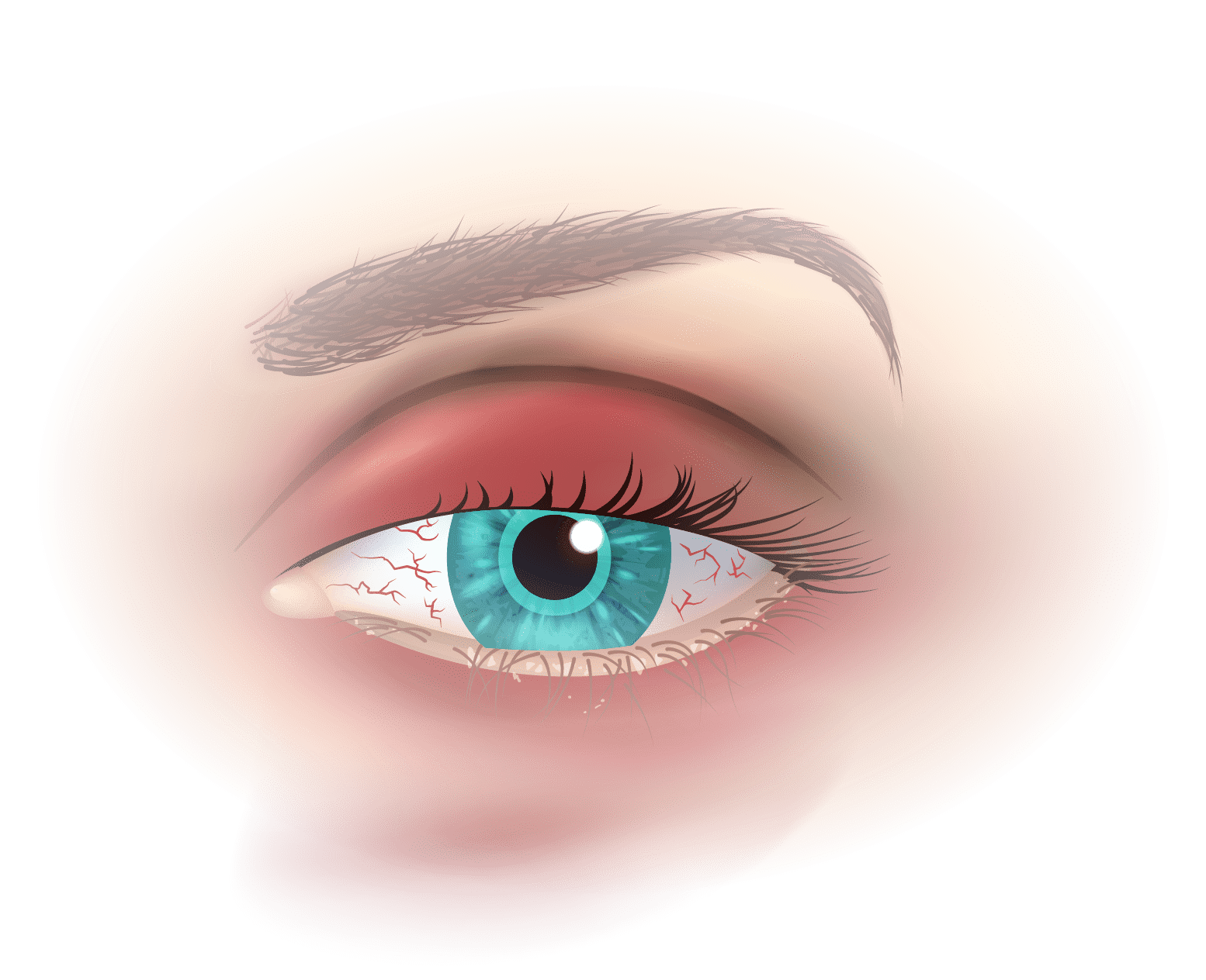 Rozpoznanie 2 analyse clinique secheresse oculaire